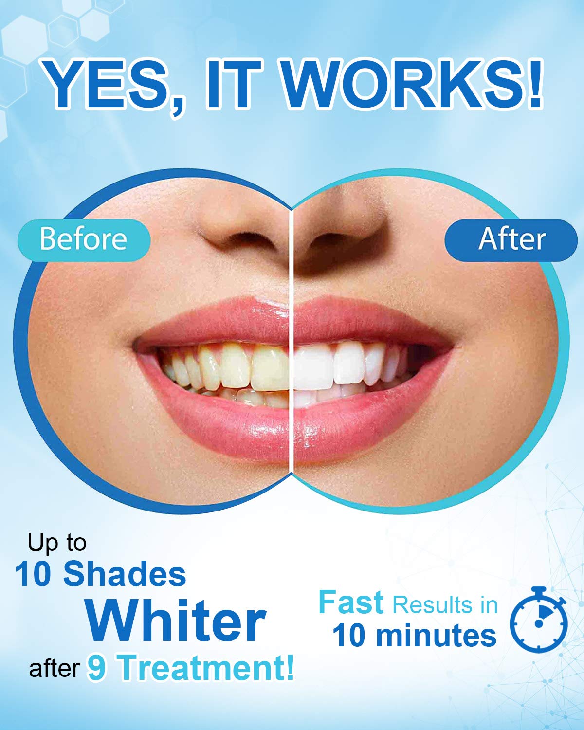My Smile | Expert Dental Whittening Pen
